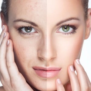 TRATAMIENTO-DESPIGMENTANTE-CENTRO-ESTETICA-EN-OVIEDO-ASTURIAS